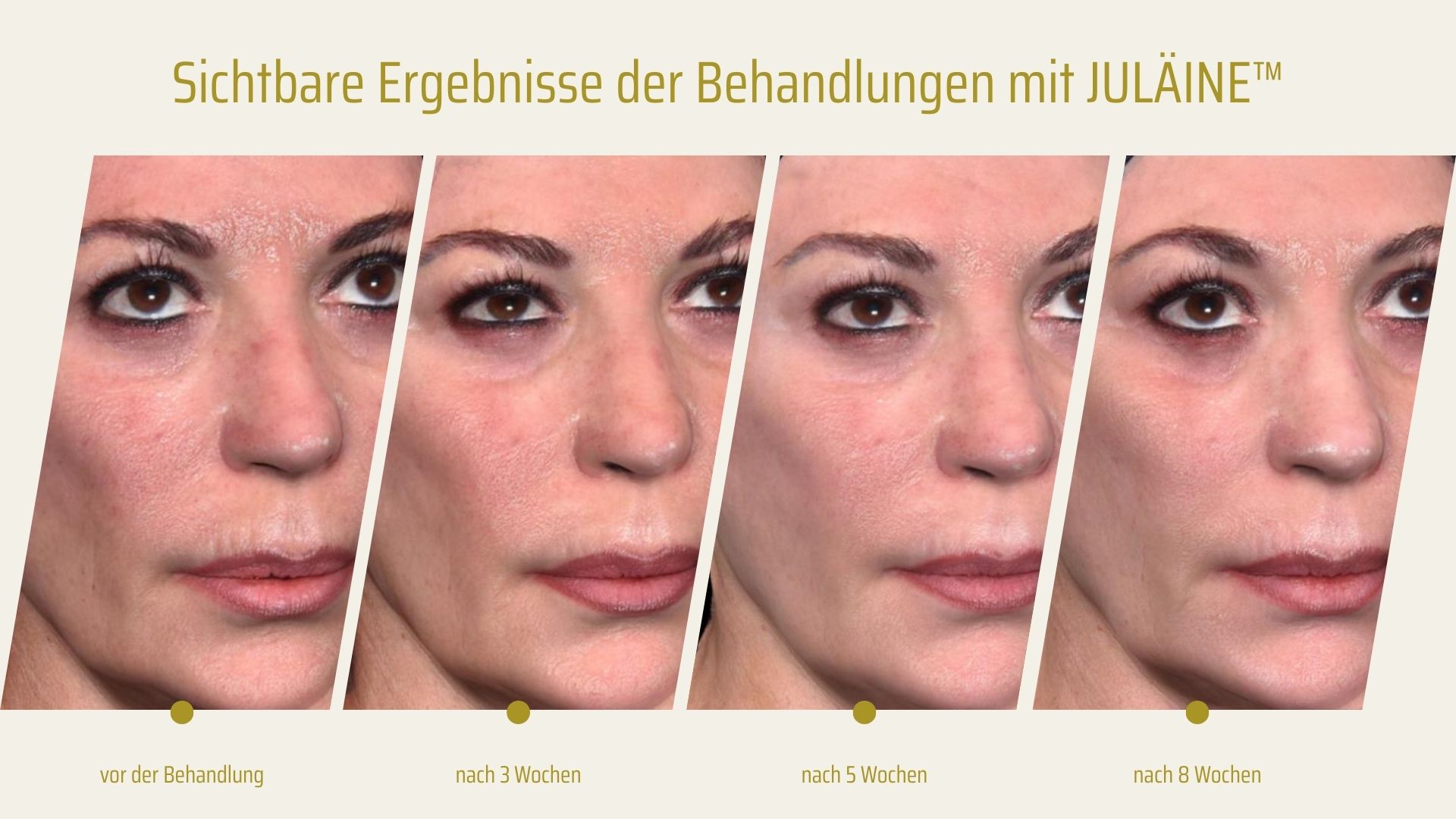 Sichtbare Ergebnisse der Behandlung mit Biostimulator Vorher Nachher in Zürich bei AVORYA